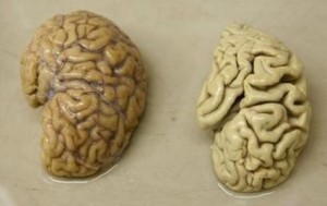 one-hemisphere-of-a-healthy-brain-l-is-pictured-next-to-one-hemisphere-of-a-brain-of-a-person-sufferin-the-neuropsychiatry-division-of-the-belle-idee-university-hospital-in-chene-b.jpg 430×273 pixels